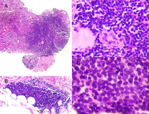 Histological characteristics of the lymphoid infiltrates that affected both the renal parenchyma (A: H&E, ×10) and the perirenal tissue (B: H&E, ×10). The lymphoid infiltrate had destroyed the parenchyma, leaving isolated residual tubules with images that may suggest lymphoepithelial lesion (C: H&E, ×20). Cells were monomorphic, small in size, with an irregular nuclear outline, barely visible nucleolus and no significant mitotic activity (D: H&E, ×40).