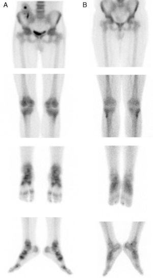 Bone scintigraphy consistent with CRPS (A) with resolution of the process in the post-treatment follow-up (B).