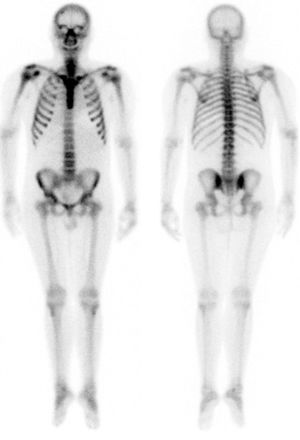 Bone scan showing a metabolic pattern related to the patient's hyperparathyroidism.