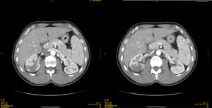 Bilateral renal perfusion defects.
