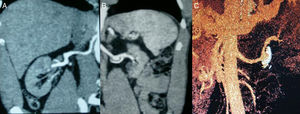 (A) Right renal artery with no signs of stenosis and right kidney with size preserved. (B) Left renal artery with no signs of stenosis; aneurysm 2cm in diameter; atrophic left kidney. (C) 3D reconstruction of aneurysm with calcified and thrombosed wall.