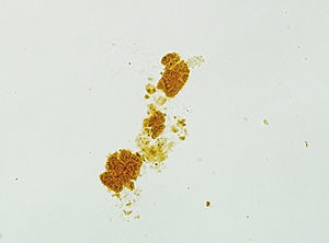 Urine sediment in which a bilirubin cast can be seen using an optical microscope (x40).
