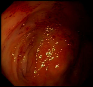 Colonoscopy. Caecal fundus with erythematous lesions measuring 2–3mm which look like small haematomas due to mucosal fragility, bearing no resemblance to angiodysplasias. There is no lesion candidate of local treatment.