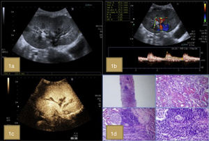 (a) B-mode study with cortical thickening and loss of corticomedullary differentiation. (b and c) Pulsed Doppler ultrasound and after administration of IVC without alterations. (d) Banff grade IA acute cellular rejection. The histological sections show a lymphoid infiltrate that affects 25% of the tissue sample (A) with interstitial edema (B) and frequent images of tubulitis (C and D) (H & E).