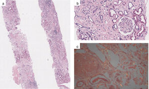 (a) View of two renal casts with amorphous hyaline deposits occupying the interstitium (haematoxylin-eosin, ×20); (b) The amorphous hyaline deposits in the glomeruli are markedly fewer than in the interstitium (haematoxylin-eosin, ×200); and (c) Amyloid deposits that turn apple-green under polarised light (Congo red, ×40).