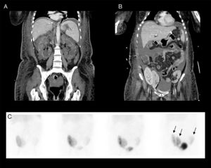 Baseline CT coronal views show policystic kidneys before the first liver–kidney trasnsplantation (A). Follow-up CT locates the three transplanted kidneys in both sides of the pelvis (B). A renogram study using 99mTc-MAG3 was performed identifying different degrees of radiotracer uptake in all three transplanted kidneys (C).