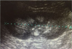 Ultrasound image of nephrocalcinosis in case 1.