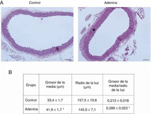 Mice with CKD induced by adenine-rich diet develop vascular structural damage. Mice were fed standard diet (Control) or rich in adenine (adenine) during 6 weeks. (A) The aortas were stained with hematoxylin-eosin. Representative changes are shown. In Control mice, no lesions are seen. Note the thickening of the media (asterisk) of the aortas of the mice fed with Adenine. Scale bar: 100μm. Magnification 20×. (B) Morphometric analysis of the thickness of the media and the radius of the lumen, made by the ImageJ software and calculation of its ratio. The mean of 5 independent measurements in different directions is considered mean radius. The values are presented as the mean±SEM. 1p<0.05 vs. Control. n=5 animals/group.