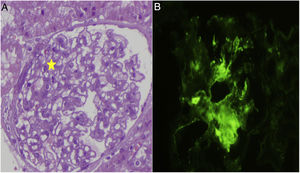 (A) Kidney biopsy. Morphologically, a slight increase in mesangial cells is observed in some glomeruli. (B) Direct immunofluorescence study in which C1q deposits are observed.