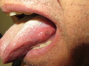 Clinical photograph shows 2 major aphthous ulcers, with surrounding edema and erythema, on the tongue.