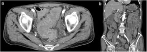 (a) Pelvic computed tomography scan at the level of the sigmoid colon. Remarkable mucosal edema was confirmed in the circumference of the sigmoid colon. (b) Abdominal and pelvic computed tomography scan (coronal view) showing severe whole-intestine edema.