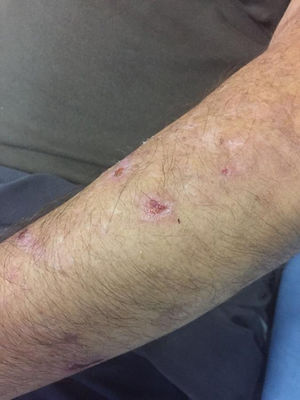 Lesions on the left forearm.