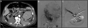 An 84-year-old patient diagnosed with renal adenocarcinoma came to Accident and Emergency with abdominal and low-back pain and in haemorrhagic shock. The CT angiogram shows bleeding from a malignant tumour with a large retroperitoneal haematoma (A). Through right femoral access and placement of a 6F introducer, the left renal artery was catheterised with the help of a Cobra 4F catheter and a guidewire (0.014″) with atraumatic tip. The renal artery was then catheterised using a coaxial technique with the help of the 4F vertebral catheter and a 6F guide catheter. Arteriogram with manual contrast injection through the guide catheter shows the large tumour with areas of active bleeding (B). From the vertebral catheter placed in the ostium of each segmental artery, the distal bed was then embolised with the injection of microspheres (300–500μm). Lastly, the segmental arteries and the renal artery were embolised with controlled-release coils (Azur, Terumo®) (C).