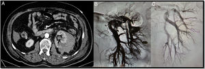 A 74-year-old postoperative patient after left upper partial nephrectomy who had frank haematuria with progressive and persistent anaemia requiring multiple transfusions. The CT angiogram (A) shows a left retroperitoneal-perirenal haematoma with two images suggestive of pseudoaneurysms. Through right femoral access and placement of a 6F introducer, the left renal artery was catheterised with the help of a 4F vertebral catheter and a guidewire (0.014″) with atraumatic tip. A selective arteriogram showed two pseudoaneurysms (B). The microcatheter 2.7F (Progreat, Terumo®) was then advanced through the vertebral catheter to the pseudoaneurysms and they were embolised with controlled-release microcoils (Detach-18, Cook®), with an optimal outcome (C).