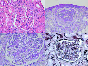 Optical microscopy: mesangial proliferation and endocapillary hypercellularity are observed. In addition, extracapillary proliferation with cellular crescents can be seen.