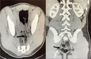 Pelvic-abdominal tomography with contrast: suggestive of inflammatory-infectious process, probable urinary schistosomiasis.