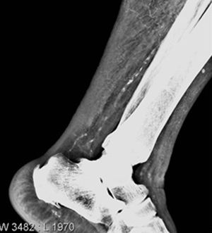 Simple X-ray of left ankle.