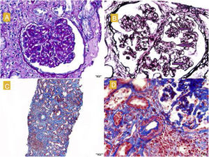A) Glomerulus with reinforcement of the glomerular pattern, mesangial cell proliferation and thickening of the capillary walls. PAS, 40 × . B) Double contour images (marked with arrows). Silver technique. C) Moderate fibrosis, tubular atrophy and lymphoplasmacytic infiltrates in the interstitium. Masson, 40 × . D) Arterioles with smooth muscle hyperplasia and decreased lumen. Masson.