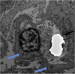 Electron microscopy with enlargement of the lamina rara interna (arrows) which can be seen in thrombotic microangiopathy.