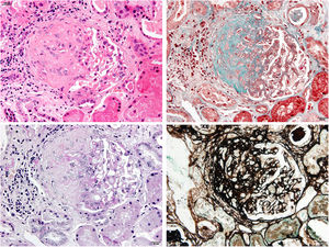 The image shows a glomerulus with a segmental sclerosing lesion (from left to right and from top to bottom, HE, Masson, PAS, silver; 40×).