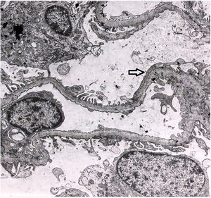 The electron microscopy study shows irregular pedicle fusion which affects approximately 30% of the capillary surface (arrow).