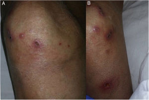 (A and B) Multiple plaques of crateriform appearance with keratosis and haematic scabs on their surface.