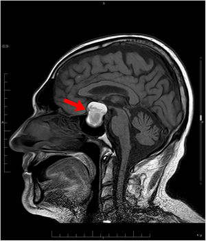 Sagittal MRI (T1). Pituitary macroadenoma with signs of subacute intralesional bleeding and pituitary apoplexy (red arrow).