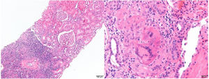 Panoramic view including two glomeruli with no significant abnormalities and tubulointerstitial patchy inflammatory infiltrate accompanied by eosinophils and tubulitis phenomena (left). Non-necrotising granuloma with multinucleated giant cells (right). Haematoxylin–eosin staining.