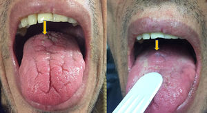 Lesion on the back of the tongue.