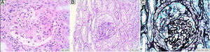 Kidney biopsy. A) Haematoxylin‒eosin staining: segmental necrotising lesion with fibrin and remnants of fragmented nuclei. B) Periodic acid–Schiff (PAS) staining: epithelial half-moon. C) Silver staining: epithelial half-moon.