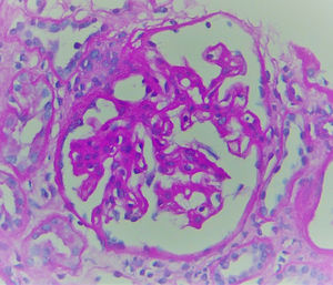 Periodic Acid-Schiff (PAS), 200×: glomerulus with thickened capillary walls, mesangial expansion and segmental sclerosis with Bowman's capsule adhesions.