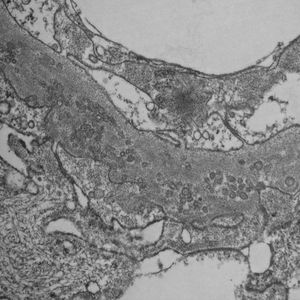 Electron microscopy: intramembranous structures with extensive podocyte foot process fusion. Absence of electron-dense deposits.