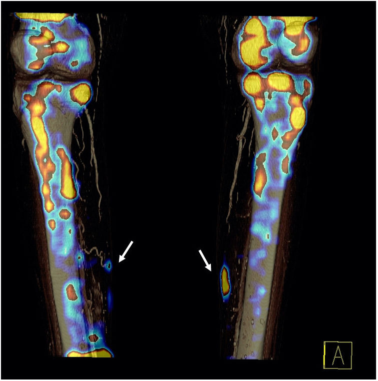 Hybrid image (SPECT/CT) in the early diagnosis of a patient with ...