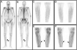 Anterior (A) and posterior (B) full-body bone scan. Early planar images of legs (vascular phase), anterior (C) and posterior (D), showing no significant bone scan findings. Late planar images (osseous phase), anterior (E) and posterior (F), with minimal tracer uptake in the medial region of both legs.
