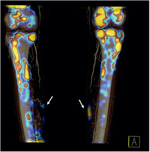 Bone SPECT/CT with 3D reconstruction.