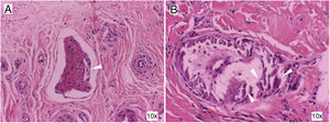 Histology with haematoxylin and eosin staining of the skin lesions. Perineural calcification (A) and medium-calibre vessel calcification (B) (arrows). These findings are consistent with calciphylaxis.