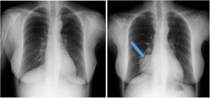 Chest X-ray prior to and after initiation of peritoneal dialysis.
