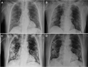 Chest X-ray showing the patient