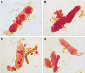Formed elements observed in urine sediment of a patient. (A) Cast with oval fat bodies. (B) Granular cast and oval fat bodies. (C) Cast of tubule cells and two urothelial cells (bottom). (D) Hyaline cast (top) and cast with lipid inclusions (bottom left). Sternheimer-Malbin stain, 40×, bright-field microscopy.
