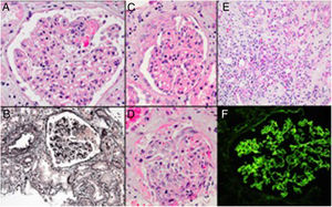 Glomerulus with focal fibrinoid necrosis (A, hematoxylin-eosin), another glomerulus with fibrinoid necrosis, which can be seen as the pink argyrophobic area in the silver stain (B, Jones methenamine silver). Glomerulus with partial cellular crescent formation (C, hematoxylin–eosin stain), another glomerulus with extensive extracapillary proliferation filling the Bowman space and part of a tubule filled with a red blood cell cast (D, hematoxylin–eosin stain). Accompanying interstitial inflammation with abundance of eosinophils (E, hematoxylin–eosin stain). Immunofluorescence microscopy showing lineer IgG along the glomerular basement membrane (F).