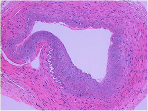 Transverse section of the temporal artery showing marked intimal thickening, without other alterations. No inflammation or infiltration by giant cells can be observed.