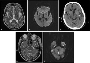 Neuroradiology imaging. A) MRI of patient 2. Hyperintense lesion on T2-weighted sequences located in lateral nuclei of the thalamus/posterior limb of the right internal capsule, consistent with lacunar infarction. B) MRI of patient 2. Restricted diffusion sequence imaging confirming stroke from prior image with an acute/subacute course. C) CT scan of patient 2. Cortical/subcortical hypodensity in the left temporal region consistent with ischaemic lesion. D) MRI of patient 3. Hyperintense lesion on T2-weighted sequences located in the cerebellar vermis consistent with infarction. E) MRI of patient 3. Diffusion-weighted imaging identifying a focus of signal abnormality in the cerebellar vermis, which restricts on an apparent diffusion coefficient (ADC) map, consistent with acute/subacute infarction in the location reported on T2-weighted imaging in the prior image.