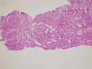 Renal biopsy which shows diffuse global basal membrane thickening, lymphocyte dominant tubulointerstitial inflammation, increased fibrosis, and tubular atrophy by light microscopy, H.E. 400×.