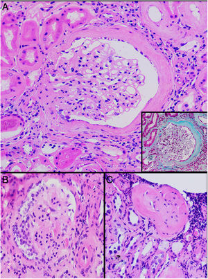 Glomerular alterations in the clinical case. (A) Glomerulus with pericapsular fibrosis and slight increase in the mesangial matrix (pericapsular fibrosis and perihilar sclerosis are highlighted in detail with Masson