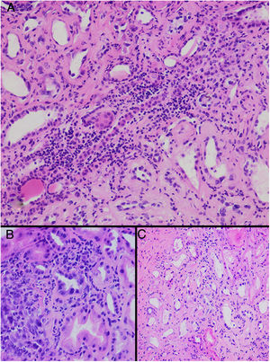 Tubulointerstitial alterations in the clinical case. (A) Marked lymphocytic infiltrate in the interstitium, accompanied by tubular atrophy (H&E, × 200). (B) Interstitial infiltrate with a predominance of lymphocytes with some neutrophils causing tubulitis, and marked tubular regenerative changes (H&E, × 400). (C) Zones of interstitial fibrosis with marked tubular atrophy (H&E, × 100).