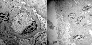The image shows a glomerular capillary loop without alterations in the basement membrane, without evidence of parietal or mesangial deposits, and with extensive but irregular pedicellar fusion. Other areas of the same glomerulus showed signs of ischemia and areas of sclerosis.
