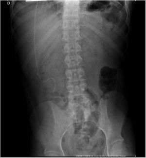 Thoracoabdominal computed tomography. Thoracic and abdominal segments of the ventriculoperitoneal shunt.