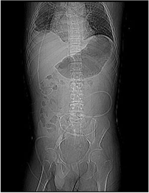 Thoracic and abdominal segments of the ventriculoperitoneal shunt, Foley catheter inserted in the Mitrofanoff appendicovesicostomy and the Tenckhoff peritoneal dialysis catheter.