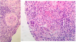 Renal biopsy: 11 glomeruli, 3 were globally sclerosed. Five with minor congestive changes and 3 with extracapillary proliferation and cell crescent formation. Tubulointerstitial compartment with chronic and acute inflammation, 30% tubular atrophy, tubular thyroidization, and 30% interstitial fibrosis. No changes in medium size vessels, or thickening of the media layer of the arteries. No congophilic deposits. Direct immunofluorescence with slight granular mesangial deposit of C3+, without deposits of IgG, IgM, IgA or restriction of light chains.