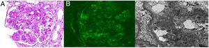 (A) Glomerulus showing moderate mesangial widening and thickening of capillary walls, as well as double contours. (Periodic acid-Schiff stain (PAS) stain, 200×), (B) Immunofluorescence microscopy showing small granular deposits of complement (C3), mainly in the glomerula mesangium (×200). (C) Electron microscopy revealing electron dense deposits in the mesangial matrix (×8000).